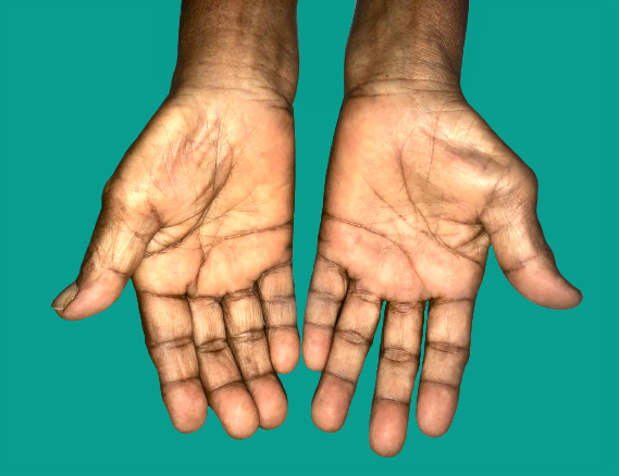 Parpeel Tunnel Syndrome
